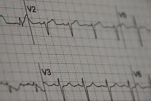 EKG