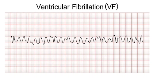 Ventricular Fibrillation